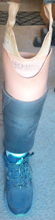 Stephanie's prosthetic leg